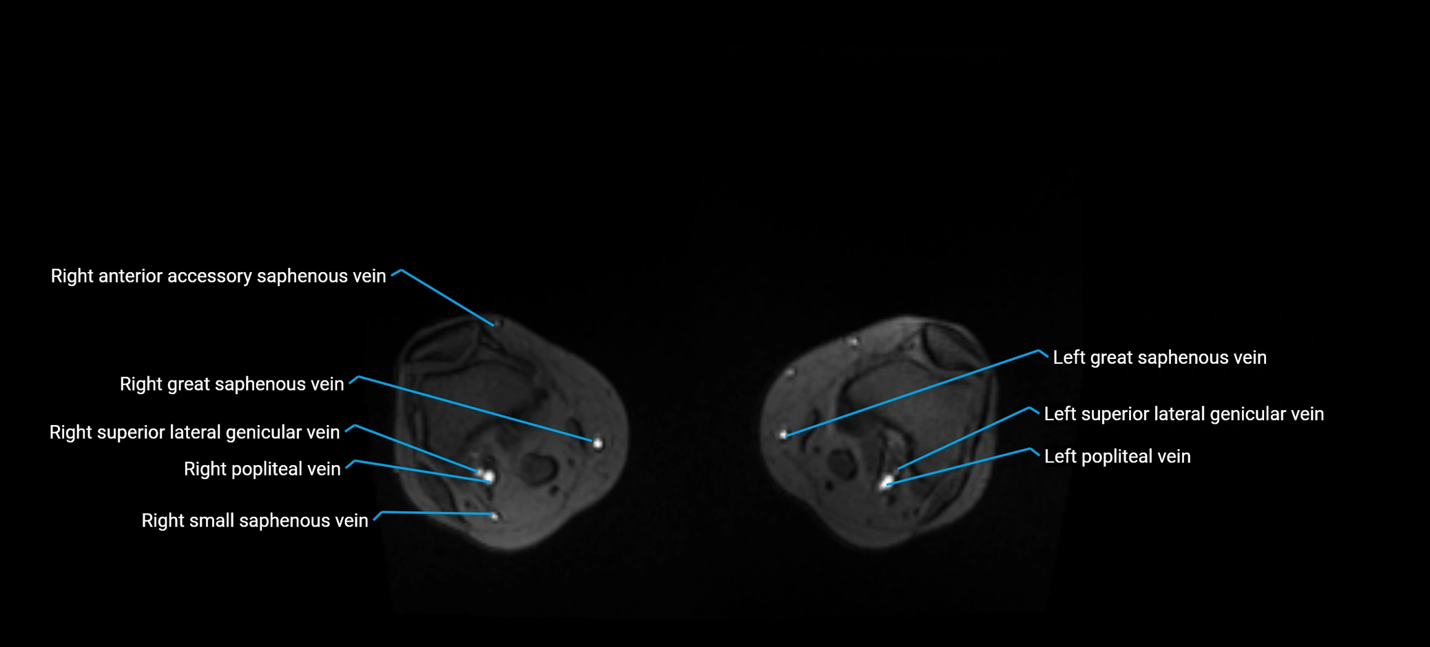 MRV abdomen pelvis & lower limb axial cross sectional anatomy labelled MRI image 357.webp